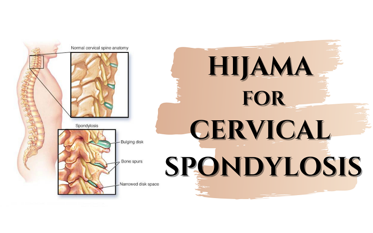 Read more about the article Cupping (Hijama) for CERVICAL SPONDYLOSIS