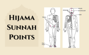 Read more about the article Hijama Sunnah Points