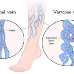 Cupping (Hijama) for VARICOSE VEINS
