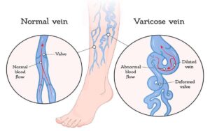 Read more about the article Cupping (Hijama) for VARICOSE VEINS